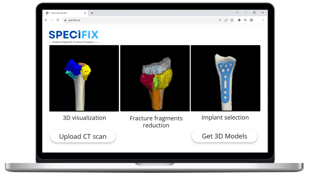Specifix: 3D planning software for wrist fracture fixation | imec