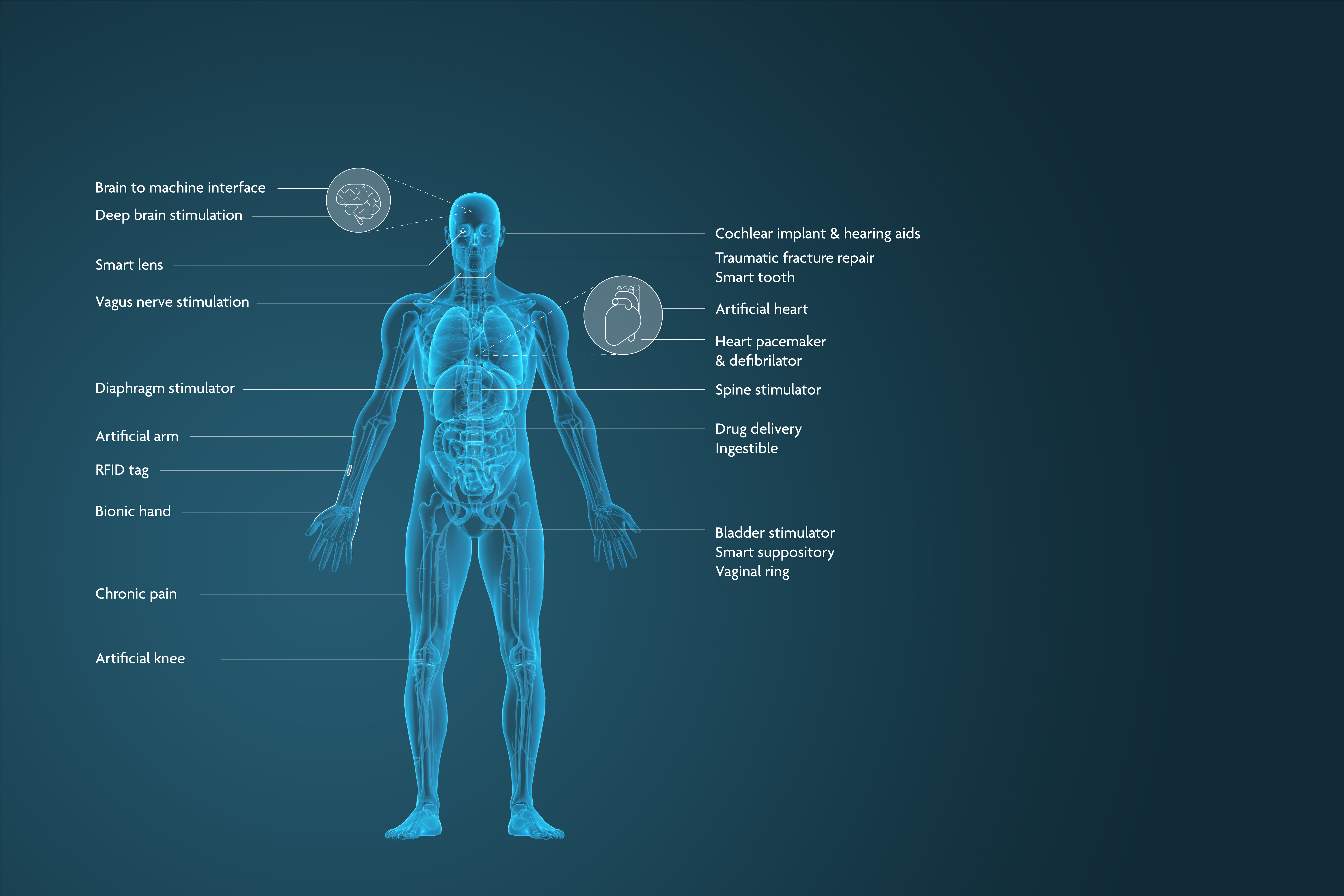 implantables