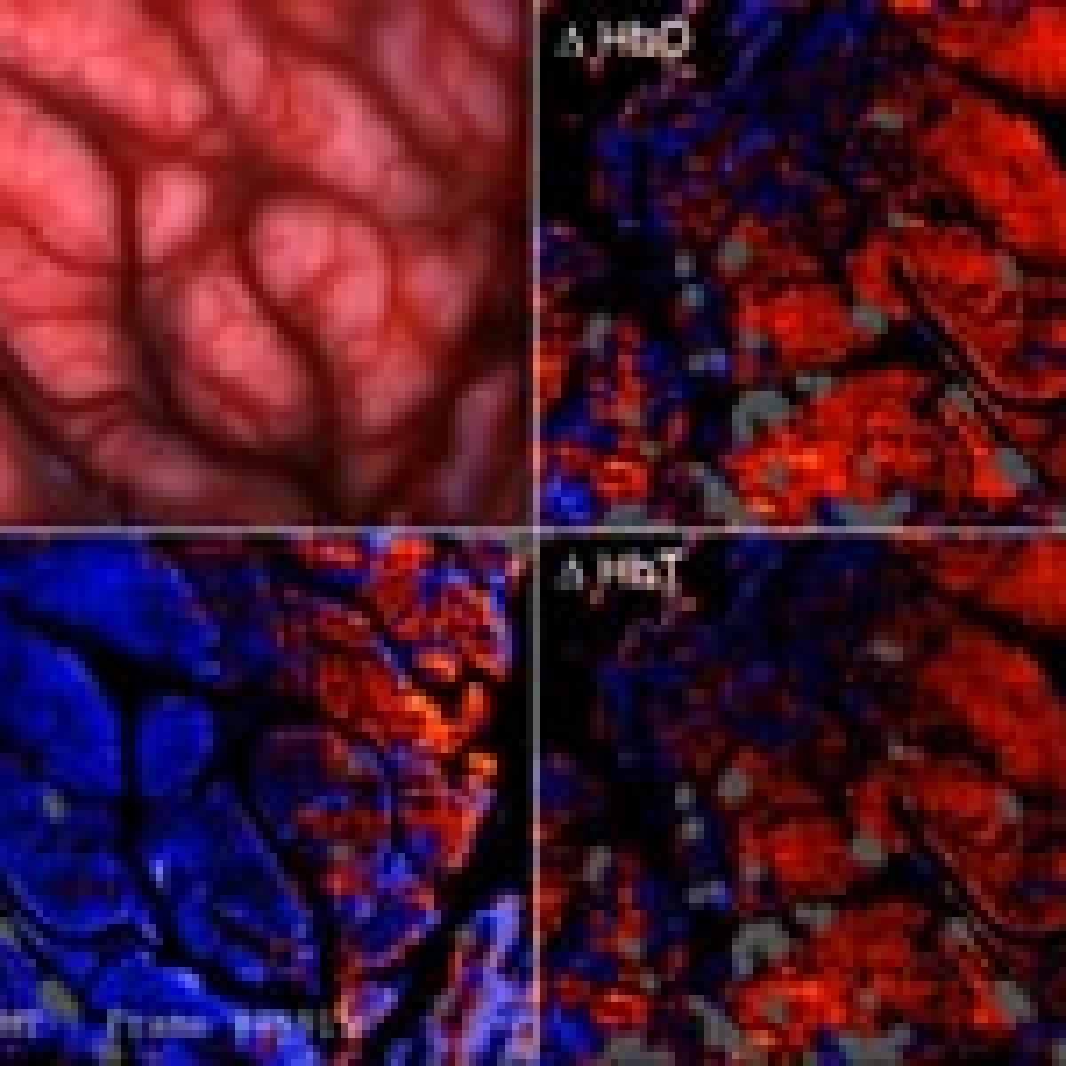 Hyperspectral imaging of brain oxygenation under epilepsy surgery